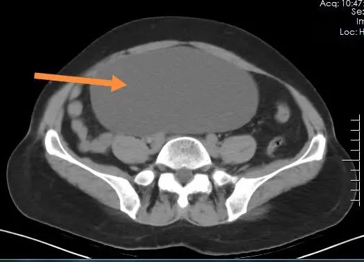52岁女子盆腔巨大肿瘤如孕6个月,南丹县人民医院妇科医师巧用微创技术为患者解难题
