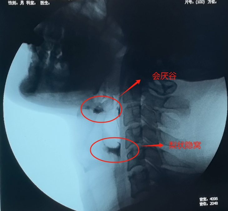 【专科技术】南丹县人民医院开展县域内首例吞咽造影检查