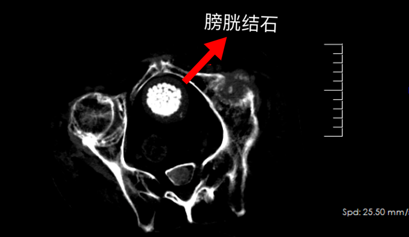 【专科技术】“镜”到石除！我院泌尿外科在男子体内取出300多颗结石！